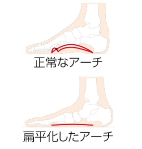 偏平足２