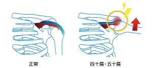 五十肩２