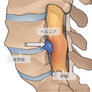 ヘルニア２